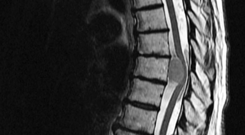 Magnetic Cement could aid better treatment of Spinal Tumours