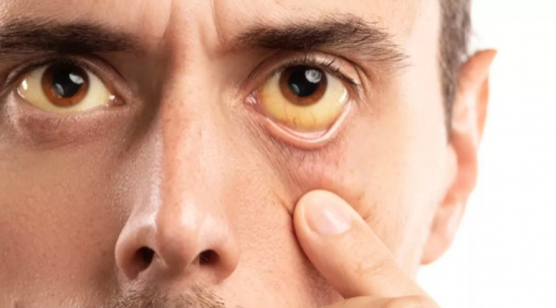 Why do the eyes and skin turn yellow in jaundice? Know what experts say
