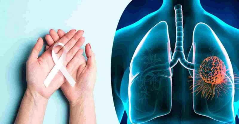 World Lung Cancer Day 2024: Why Lung Cancer Remains Deadly; Stay informed, Stay healthy!