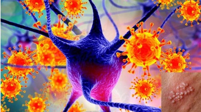 Will Chickenpox Virus Trigger Alzheimer’s?