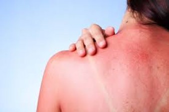 These 5 damages can happen to the skin due to sun poisoning, know the ways to prevent it
