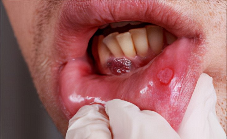 Oral cancer may be detected without the need of biopsy