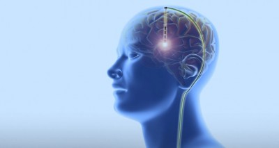Deep Brain Stimulation: A Promising Approach for Memory Consolidation