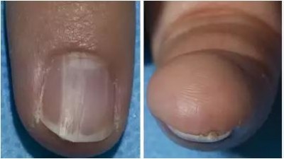 You can detect the risk of any major disease from your nails, do not ignore this warning science even by mistake