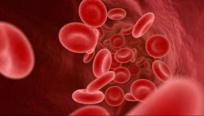 What is Sickle cell anemia, and how to prevent it?