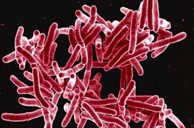 Study  reveals, Covid-19 can activate dormant bacterial infection, tuberculosis