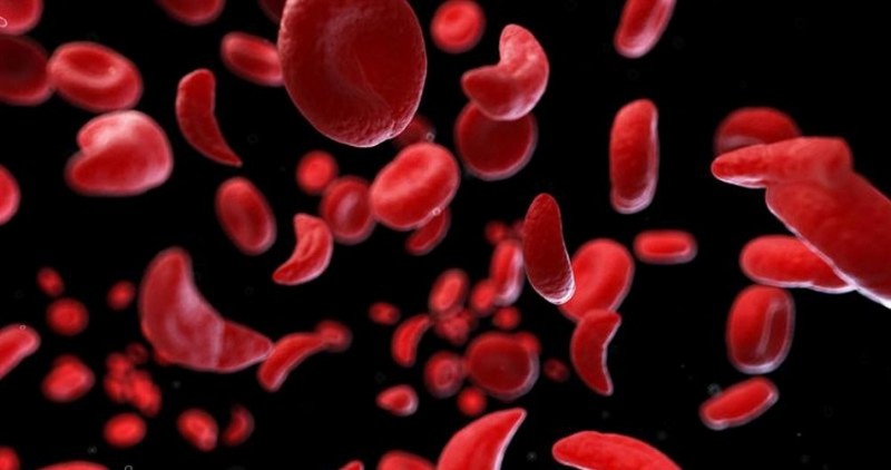 World Sickle Cell Day: Understanding Sickle Cell Disease; Symptoms, Treatments, and More