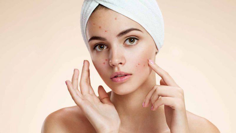 Make cleanser at home to fight with Acne problem