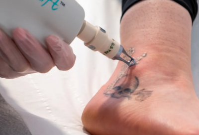 Permanent Tattoo Removal: Want to get rid of a permanent tattoo