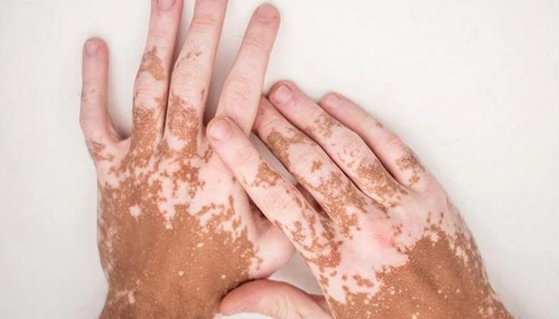 Understanding Vitiligo: Causes, Symptoms and Prevention