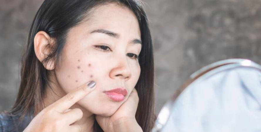 Habits that can become the cause of dark spots on the face