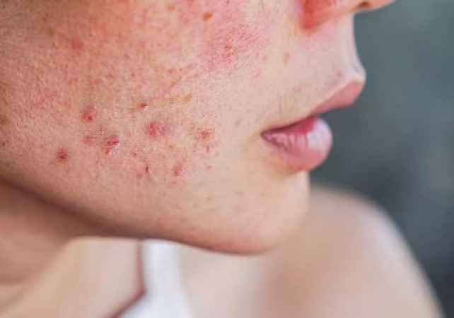 Are you also getting pimples on your face due to periods? So get rid of them like this