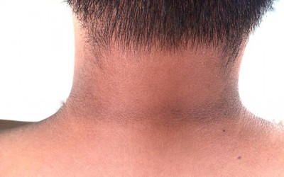 If there is blackness on the neck, do not take it lightly, it can be a sign of a serious disease