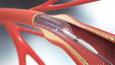 What is Angioplasty?