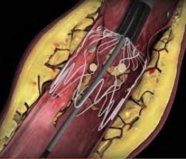What is leg angioplasty and how is it done? Know its estimated cost
