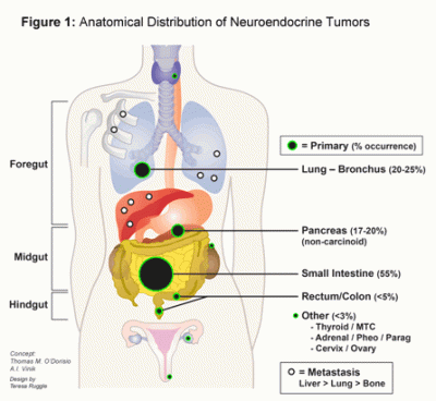 Neuroendocrine Tumour: Know about the disease, its types and survival rate here
