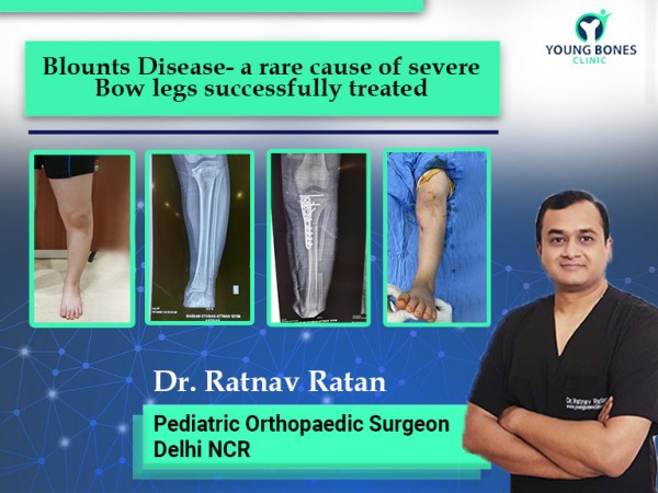 Dr. Ratnav Ratan, Delhi stresses on early surgical treatment to improve the lives of children with the Blounts’s Disease