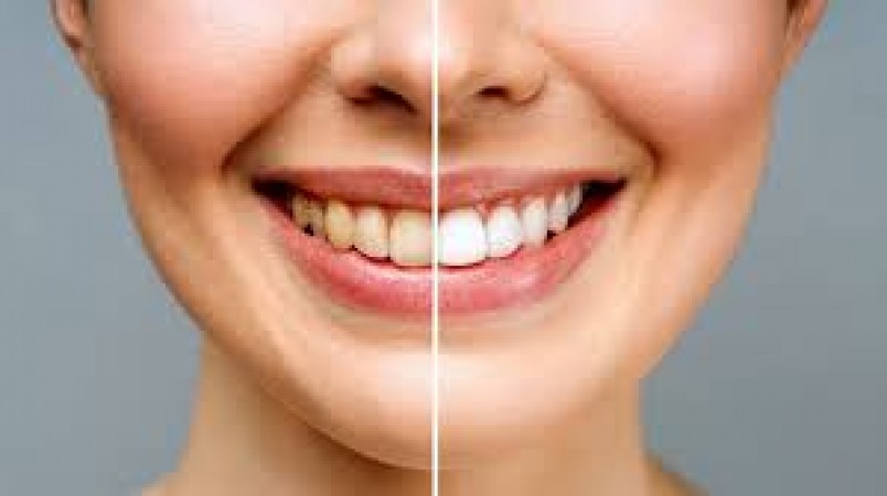 If you feel shy due to yellow teeth, then these remedies will clean your teeth in 15 days