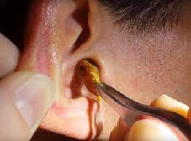 If there is earwax accumulated in the ears, be careful, otherwise this major disease may occur!