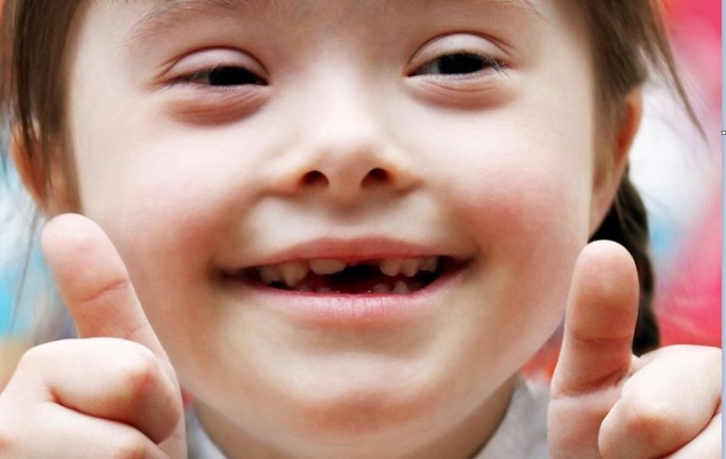 Down Syndrome – What Causes It and What Is It Exactly?