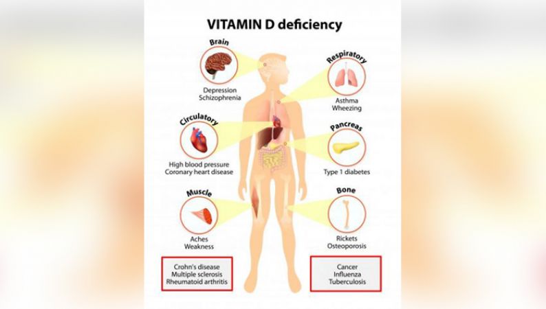 Some Names of Life-Threatening Diseases Caused By Vitamin D Deficiency