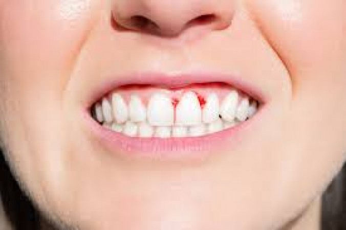 Do your teeth also bleed while brushing? Know its reason and ways to avoid it