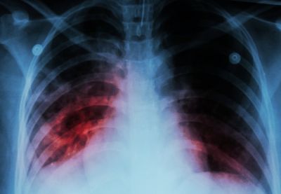 Don't ignore these uncommon symptoms of tuberculosis