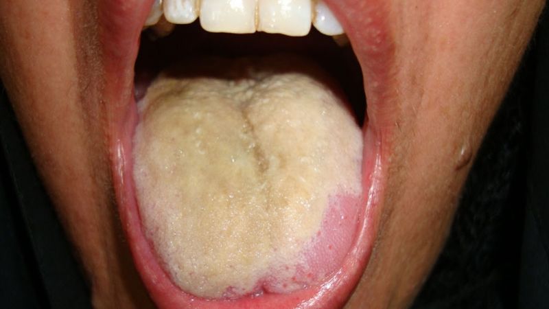 13 Causes of the White Coated Tongue