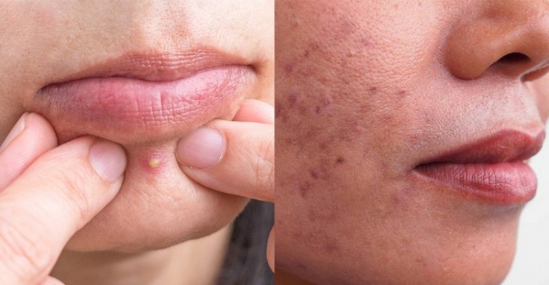 These 7 Natural Remedies Will Help You Banish Pimples and Achieve Clear Skin