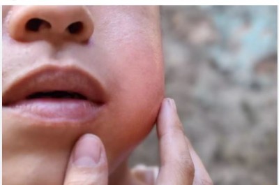 Cheeks of children are swelling like balloons, after Corona, now this virus has become famous, know what is Mumps and its symptoms