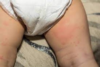How to make children wear diapers so that they do not get rashes?