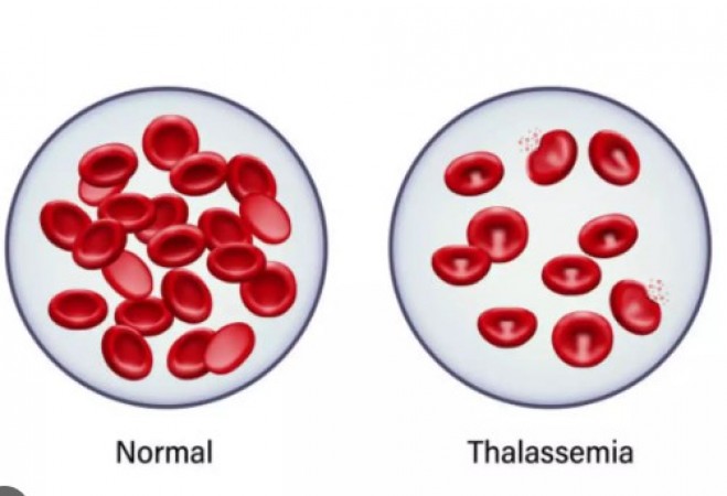 किन बच्चों को थैलेसीमिया है, शुरुआत में कैसे करें इस बीमारी की पहचान