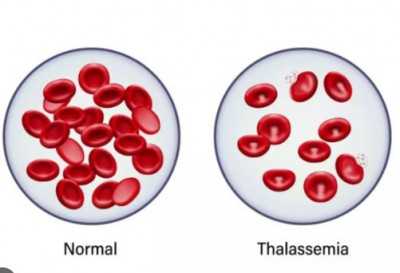 Which children have Thalassemia, how to identify this disease in the beginning