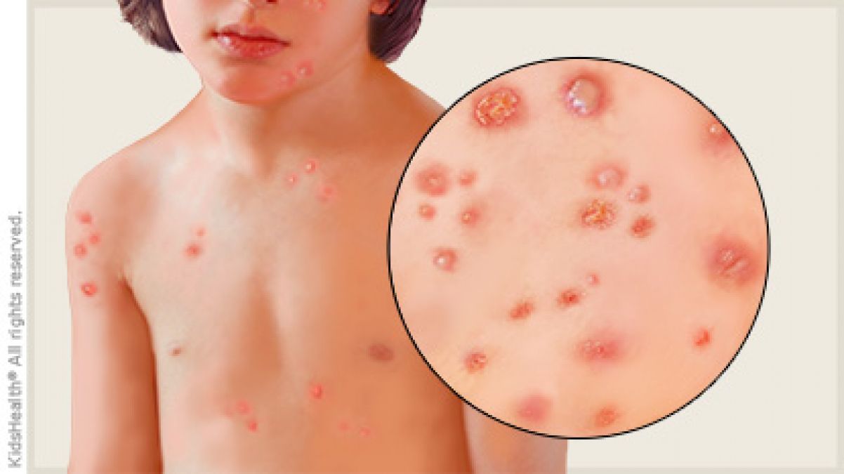 Chickenpox in children and adults: how not to get sick and how to treat