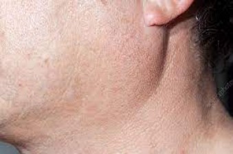 Salivary gland cancer is very dangerous, know its symptoms and take precautions like this