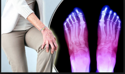 Cure Arthritis Joint Pain at home by these simple tips