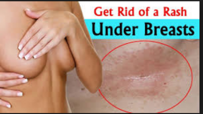 Home remedies to treat the rashes under the breasts 