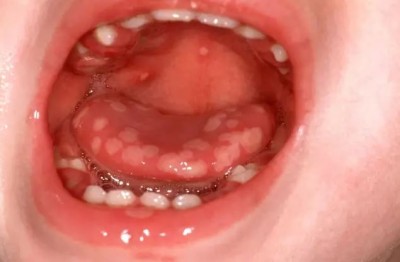 Are mouth ulcers troubling you? Find relief with these home remedies