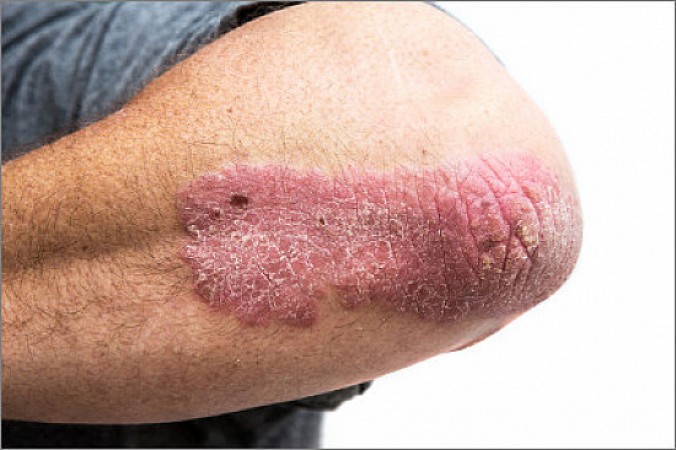 Psoriasis can also spoil heart health, go to the doctor as soon as these symptoms appear