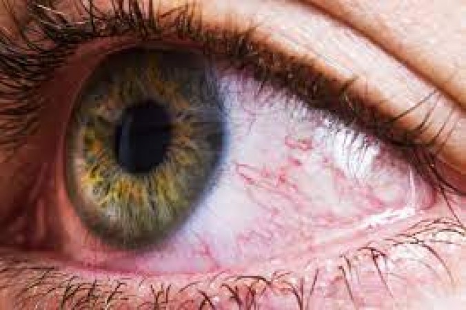 Bloodshot eyes are symptoms of silent killer disease, problem if ignored