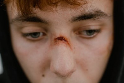 क्या नाक पर बार-बार घाव होते हैं? हेल्थ एक्सपर्ट से जानिए क्या है इससे बचने का उपाय