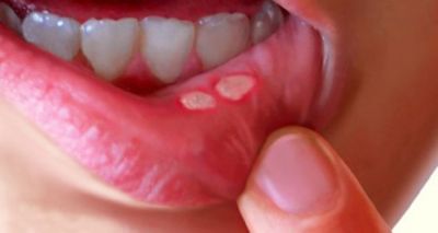 These homemade remedies  useful to wipe out  mouth blisters