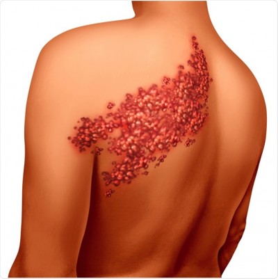 Know About Shingles And Stress It Causes In Real