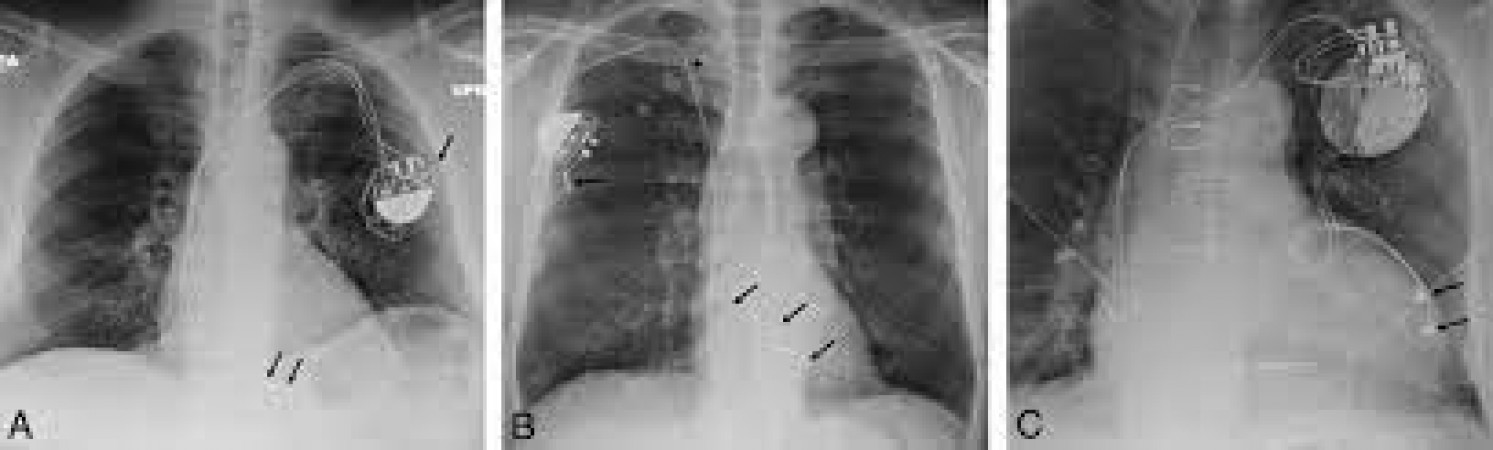 What is the difference between MRI pacemaker and non-MRI pacemaker, know when it is needed?