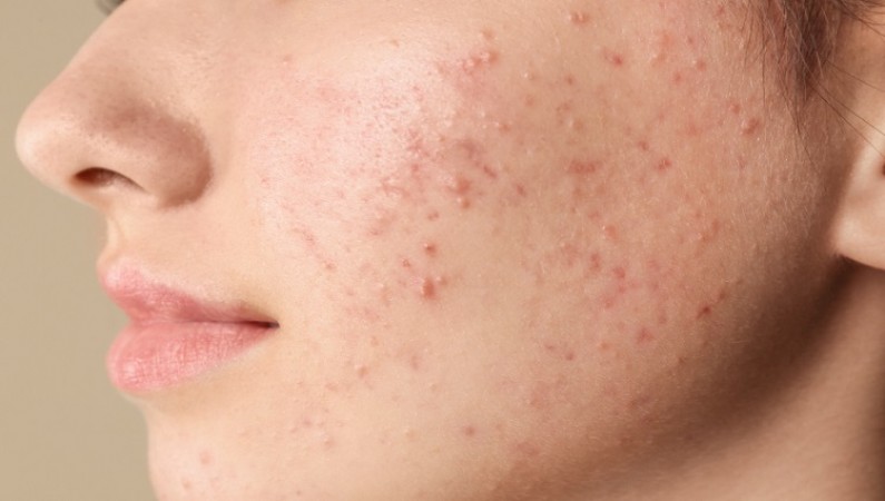 Try These Natural Remedies for Acne, Dark Spots, Blemishes, and More for Radiant Skin