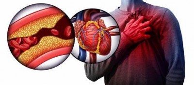 Know which of your habits can increase the risk of heart attack, why arteries get blocked