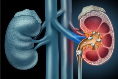 Study finds Ultrasound can be used to move, break up kidney stones in awake patients