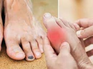 These changes seen in the feet are a sign of increasing cholesterol