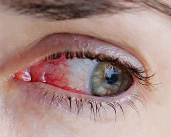 Try these tips to get rid of red eyes at home