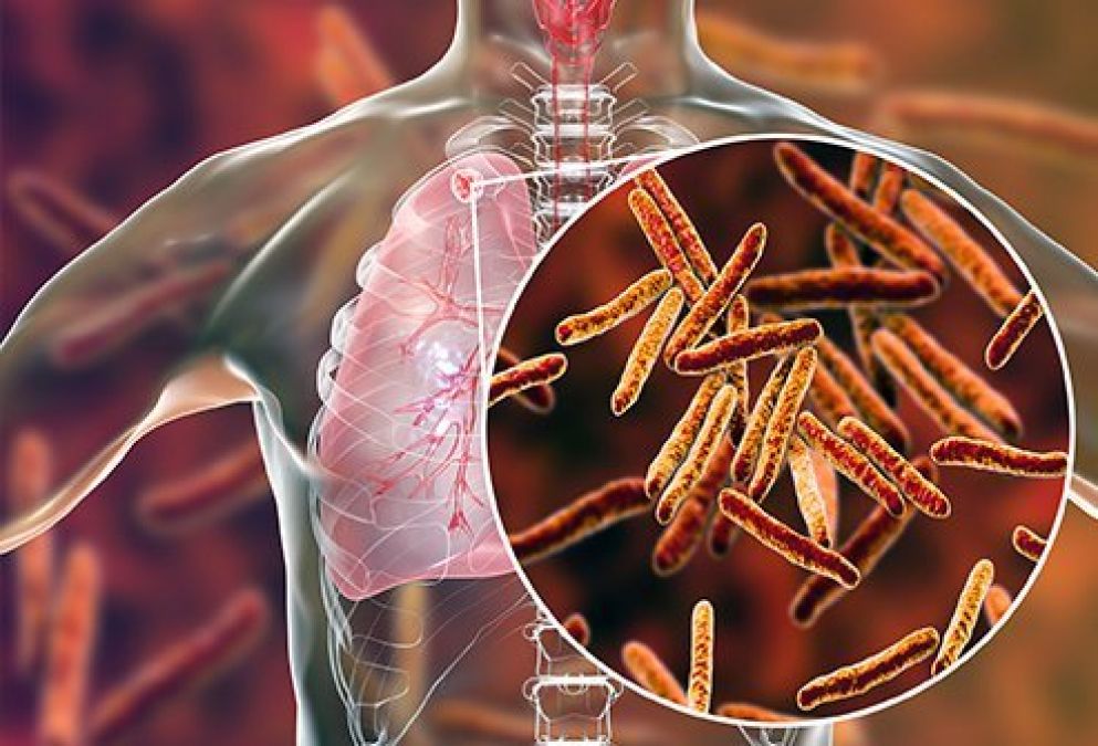 Do not overlook TB disease, it can affect other parts of the body as well as the lungs